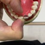 前歯CR充填でストリップスを巻いた後の指の位置関連動画