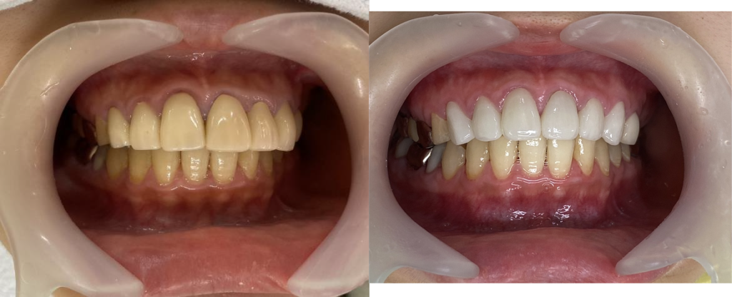 審美歯科：施術前（左）施術後（右）