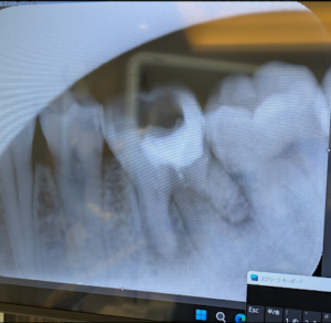 遠心舌側根っぽい