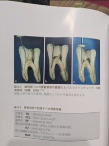 難しい根管治療についてのご質問4
