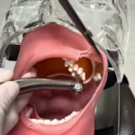 左上大臼歯形成ミラーテクニック