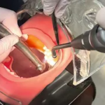 左上大臼歯形成ミラーテクニック2