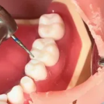 左下大臼歯インレー形成