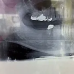 平行に埋入したい！そんな時のインプラント埋入手術