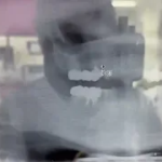 隣在歯まで近い！そんな時のインプラント埋入手術