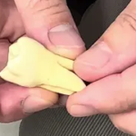 左上6番院内仮歯作成